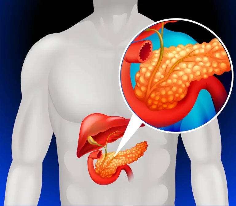 PRISM: Advancing Early Detection of Lethal Pancreatic Cancer with AI-Driven Risk Prediction Models