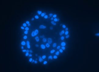 Scientists Identify New Factors that Can Predict Breast Cancer Recurrence breast cancer recurrence