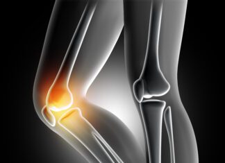 Resistance Genes Identified can Predict Response to Arthritis Treatment and Lays Foundation for Future Drug Development