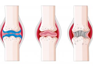 Scientists Develop a New Computer Vision Model with Improved Proficiency to Differentiate Rheumatoid Arthritis from Osteoarthritis in Damaged Joint Tissue computer vision model with improved proficiency to differentiate rheumatoid arthritis from osteoarthritis