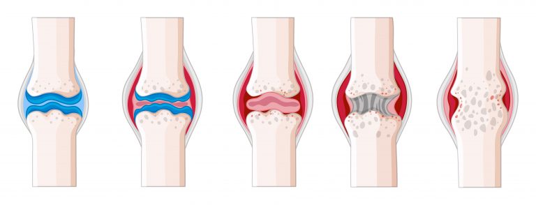 computer vision model with improved proficiency to differentiate rheumatoid arthritis from osteoarthritis