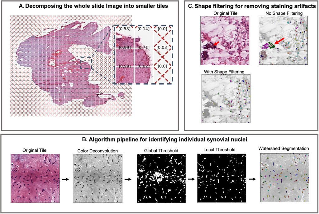 computer vision model with improved proficiency to differentiate rheumatoid arthritis from osteoarthritis