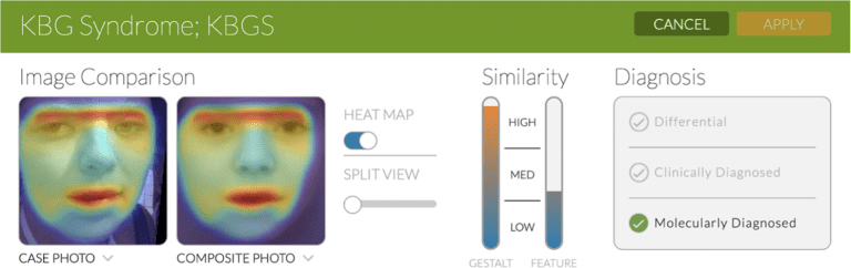 Facial Phenotyping for KBG Syndrome