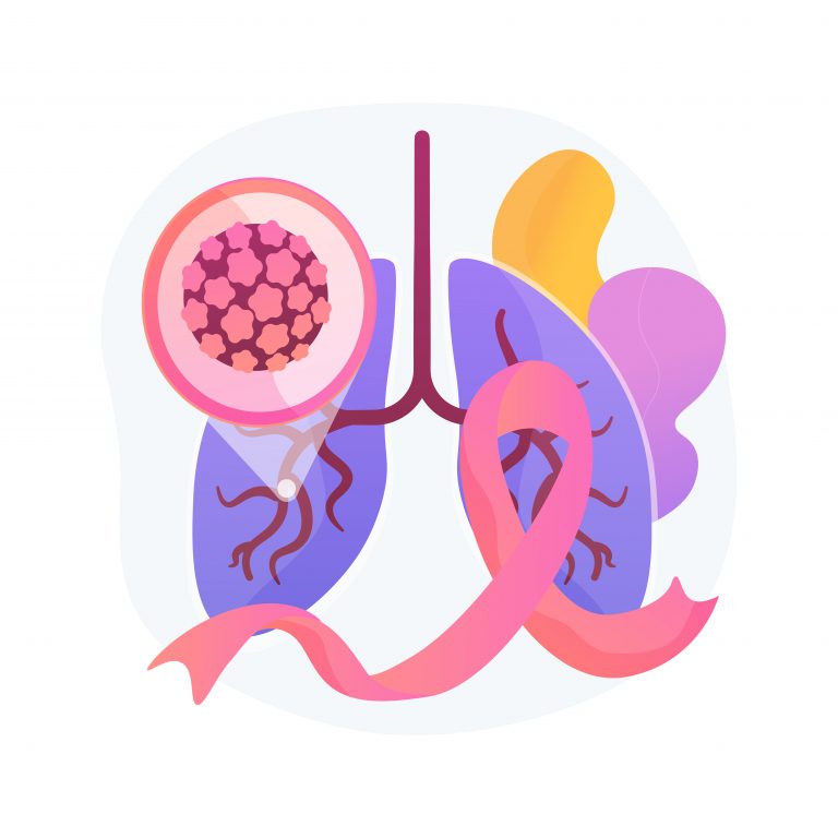 Deep Learning Algorithm to Simplify Lung Cancer Radiotherapy Treatment