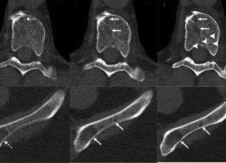 Scientists Develop an Improved Method for Detecting Myeloma Bone Disease using Deep Learning Coupled Photon-counting CT