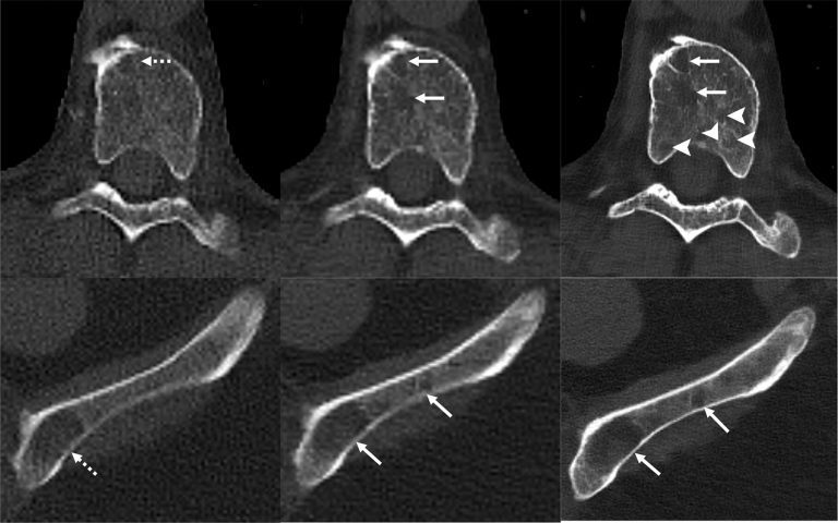 Scientists Develop an Improved Method for Detecting Myeloma Bone Disease using Deep Learning Coupled Photon-counting CT