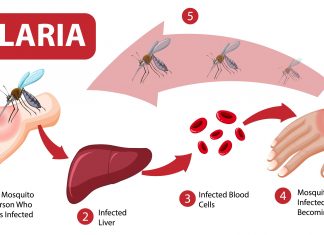 Data Dimensionality Reduction Promotes Stage-specific Malaria Detection Based on Neural Networks Stages of malaria