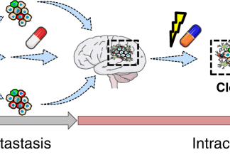 Scientists Decipher the Molecular Subsets Involved in Brain Metastases of Melanoma Molecular Subsets Involved in Brain Metastases of Melanoma