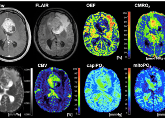 Deep Learning and Radiomics: A Game-changer for Identifying Glioblastoma and Brain Metastases Deep Learning and Radiomics: A Game-Changer for Identifying Glioblastoma and Brain Metastasis