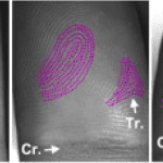 Mystery of Unique Fingerprint Pattern Formation