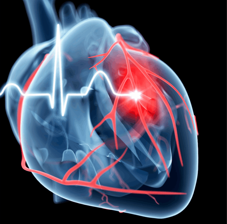 Predicting Heart Attack Risk Faster and More Accurately than Current Methods: The Role of Machine Learning in ECG Diagnosis